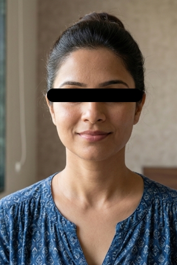 Neck & Decolletage - After